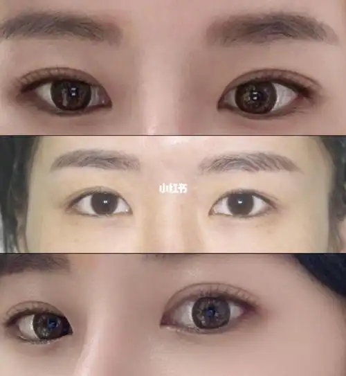 埋线,维持了两年多,不知是怎地右眼的线就松了,双眼皮也是时有时无了