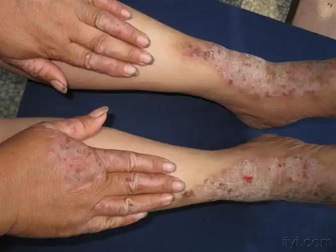 看图识病神经性皮炎
