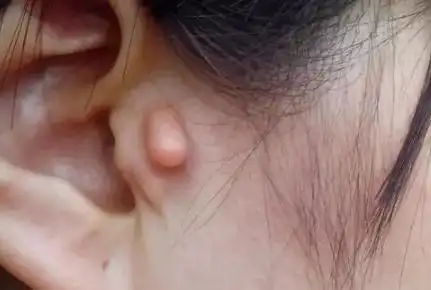 耳朵长了一个小肉球怎么回事