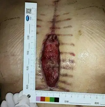 开胸术后伤口愈合不良,徐州仁慈医院慢创科成功治愈