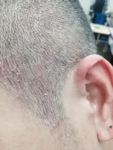 为什么有小红点又有头皮.