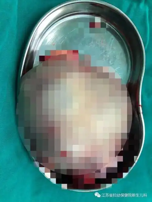 崩溃厦门一女子怀孕5个月发现胎儿竟有尾巴医生说