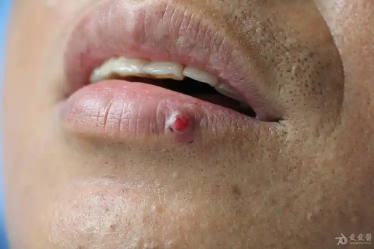 化脓性肉芽肿一例