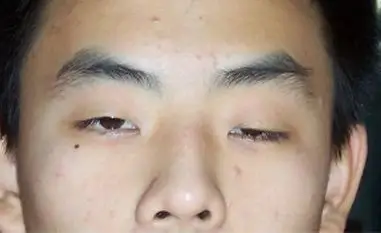 上睑下垂矫正手术方法