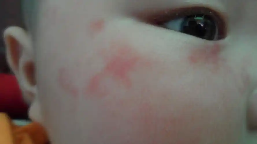 婴儿脸上红斑,出生到现在7个月大,该处红斑从出生到现在一直未消退.