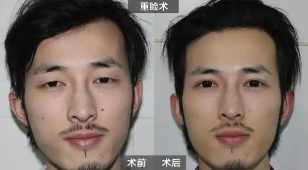 能请各位男性知友给我上一些男生整容前后的对比图吗?