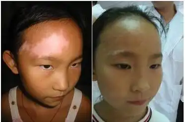 男友得了白癜风怎么办 39健康问答网_南昌治疗白癜风