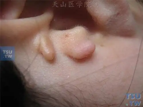 副耳(accessory auricles)耳屏前小结节