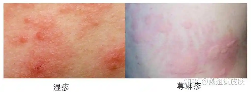 荨麻疹和湿疹需要注意的共同事项:寻找病因并隔离过敏源:找出并避免