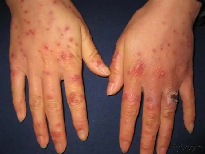 看图识病多形红斑