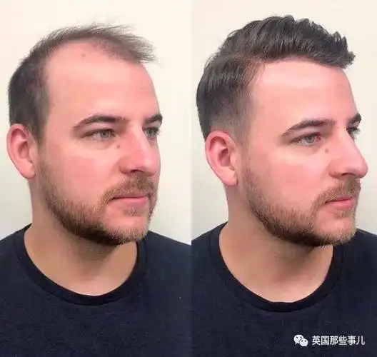 理发师专让秃顶的男人找回自信这效果简直犹如换头啊