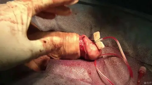 08:42   国外海绵体麻醉包皮环切    下载的是视频,不是图片,第一个