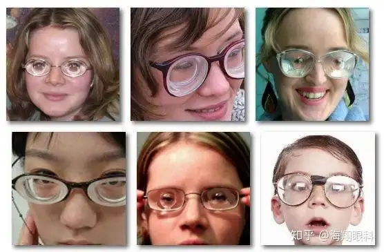 高度近视只是镜片比别人厚!真的如此简单? - 知乎