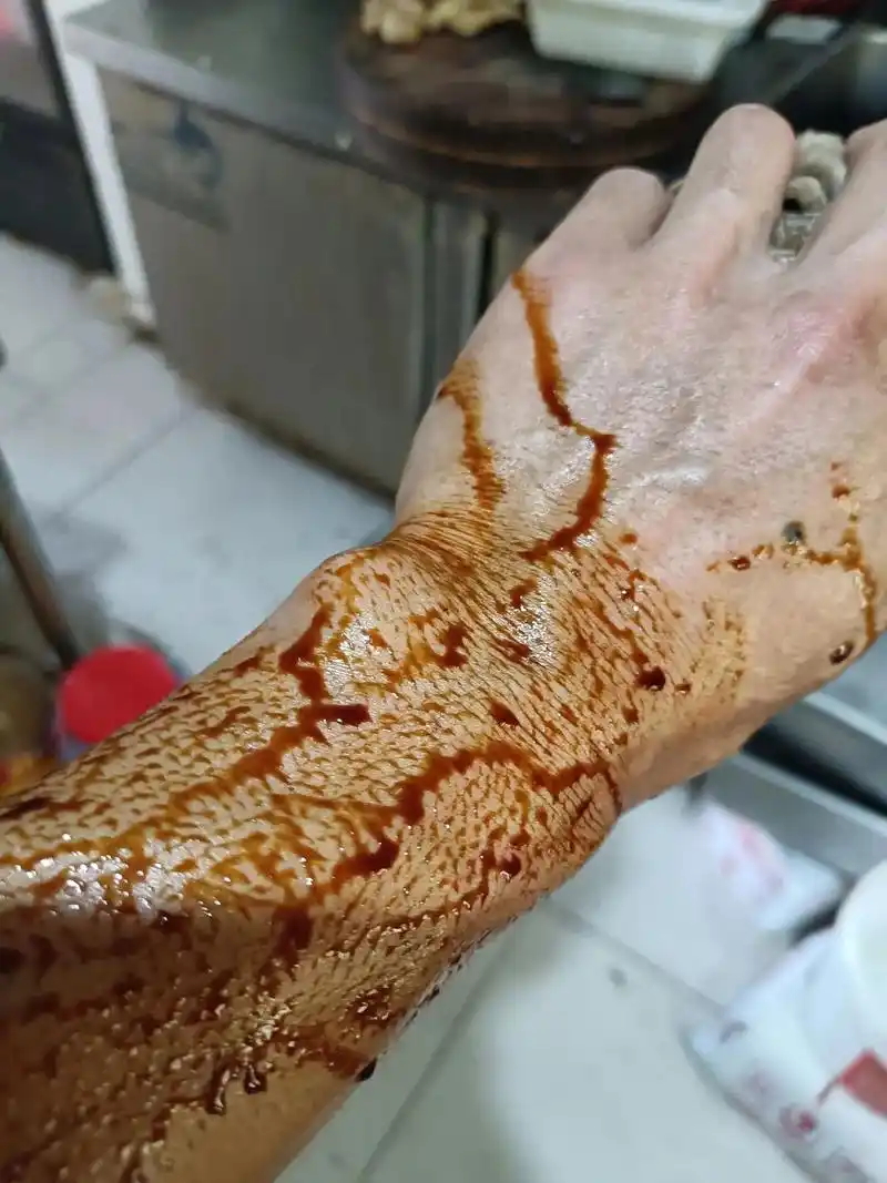 今天不小心烫了一下,别人问 - 抖音