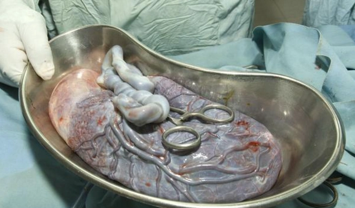 32岁孕妇长期吃胎盘,突然发冷高烧,医生检查怒斥差点命丧黄泉