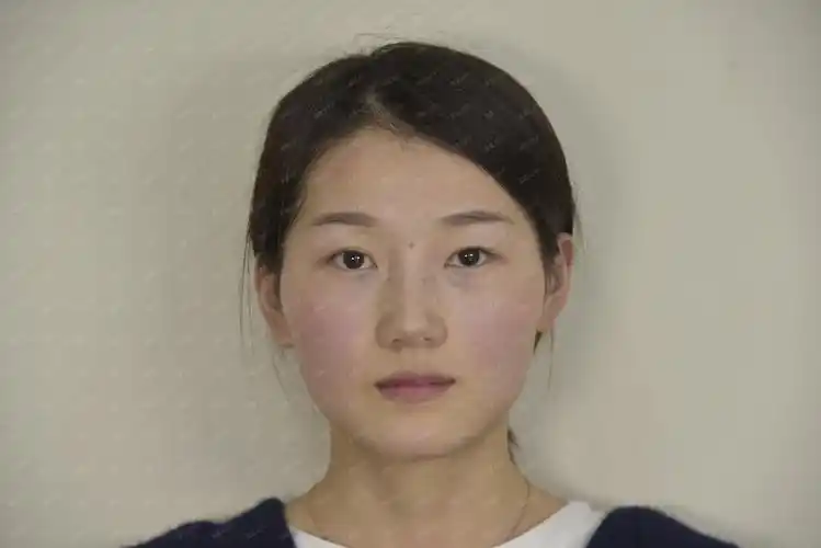 轻度上睑下垂内双的同时伴有内眦赘皮双眼皮不对称