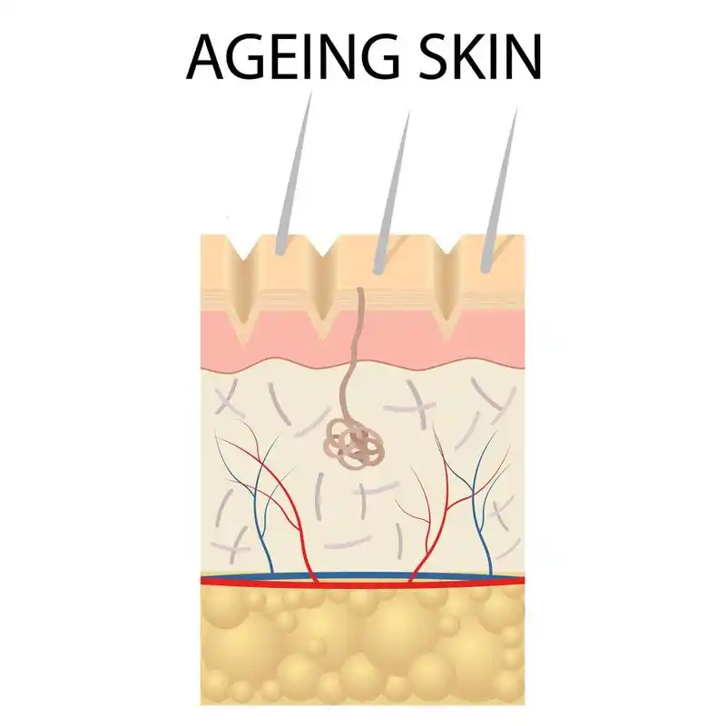 混合型肌肤  混合型肌肤是指t型区皮肤油性,而两颊和下巴部位干燥