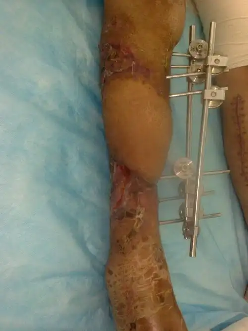 应用显微外科技术修复严重毁损,频临截肢的肢体 - 好大夫在线