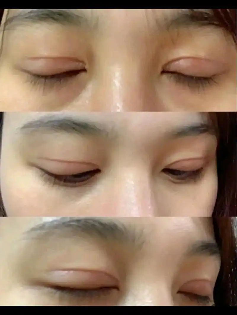 埋线双眼皮适合人群:上睑皮肤没有重度松弛的中青年求美者