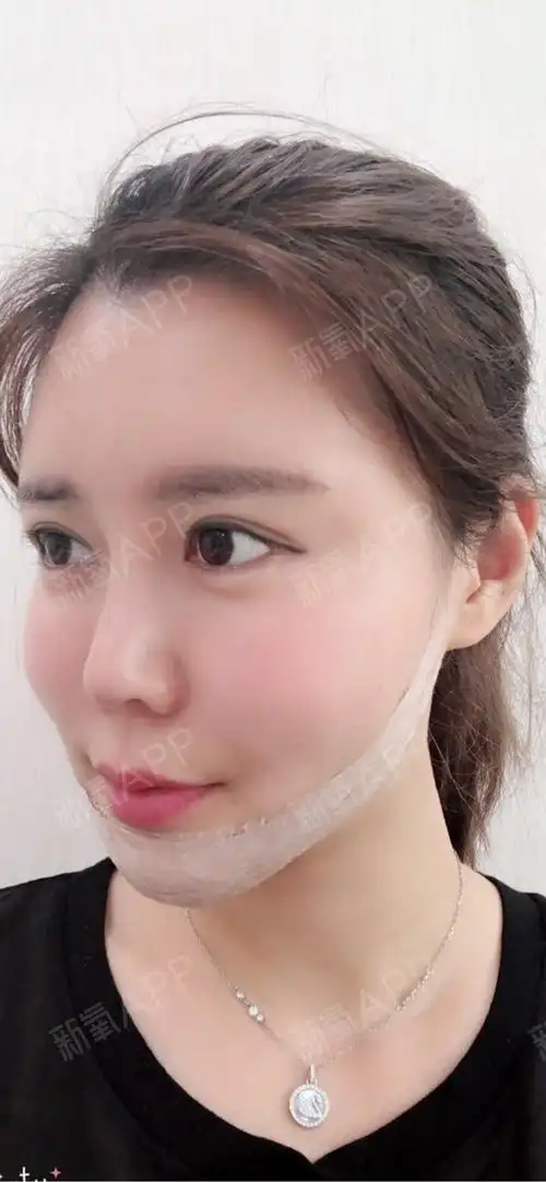 郑州自体脂肪全脸填充好不好_效果图_莉姐儿自体脂肪全脸填充术后第4