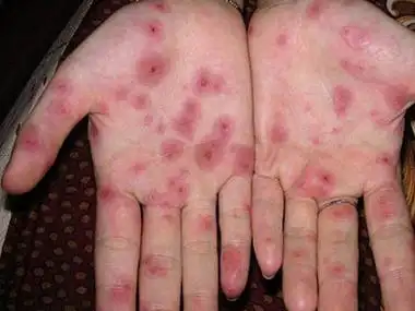 王利兰:毛囊炎和梅毒的区别图,看图秒懂!