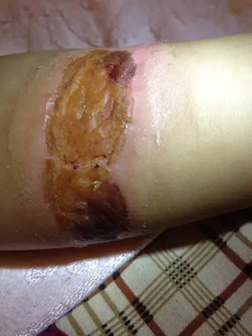 第9天 已经结痂 周边还有一些小痘 请问下恢复的怎么样呢?