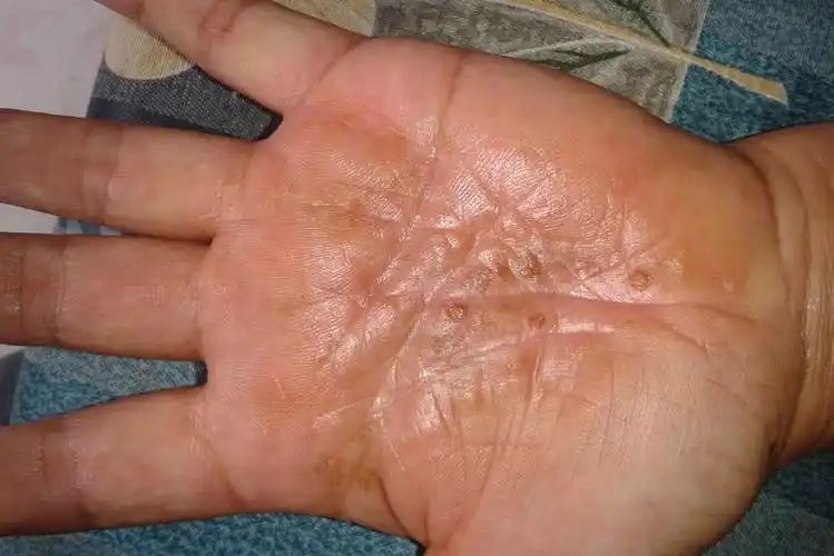 脂溢性皮炎早期症状通常表现为黄红色斑,斑片或斑丘疹,表面覆油腻性