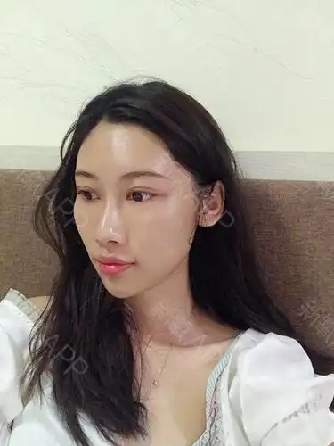 自体脂肪面部填充