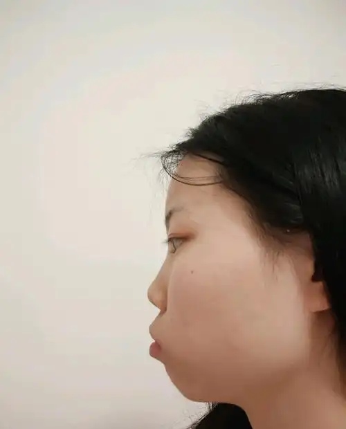 侧脸真的丑哭了,牙齿矫正能治么?