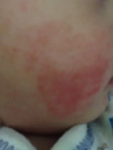 宝宝这脸上红红的一片好久了还不好,这怎么办?