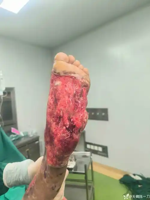 足的皮肤坏死--植皮-康复锻炼.