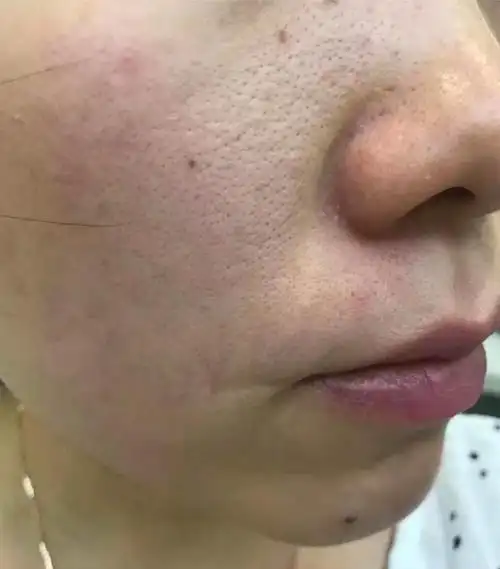 脸上毛孔粗大怎么办?怎么收缩毛孔?