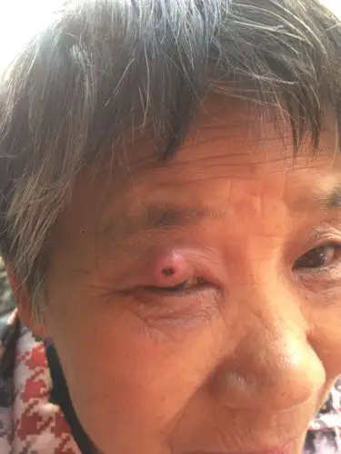我奶奶的眼睛上长了个脓包,她说不疼不痒,碰到了呢会有一点点疼,去了