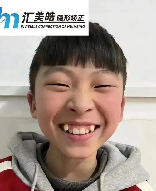 消失的虎牙～ 恭喜小朋友矫正结束 没有虎牙颜值是不是更高