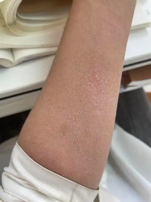 冬天皮肤干燥起皮北方室友说是该搓澡了