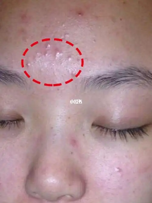 脸上因为毛囊炎变成这样了!靠它改变!