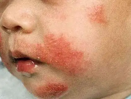 四,湿疹(eczema)见下图