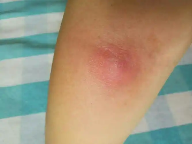 疖肿,听医生话抹了三天鱼石脂了,没拔出脓液,现在肿痛,胳膊弯曲也疼