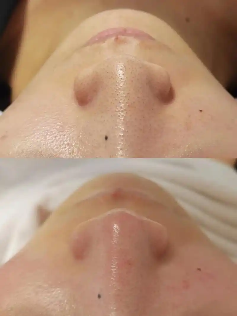 毛孔深层清洁对比图 平时油脂分泌旺盛,容易毛孔堵塞引发痘痘 - 兑趑