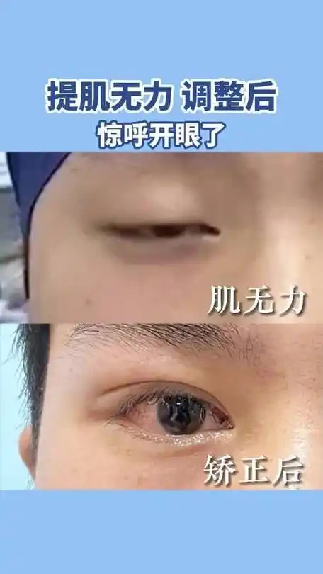 提肌无力,睁不开眼睛,术后眼睛自然明亮.
