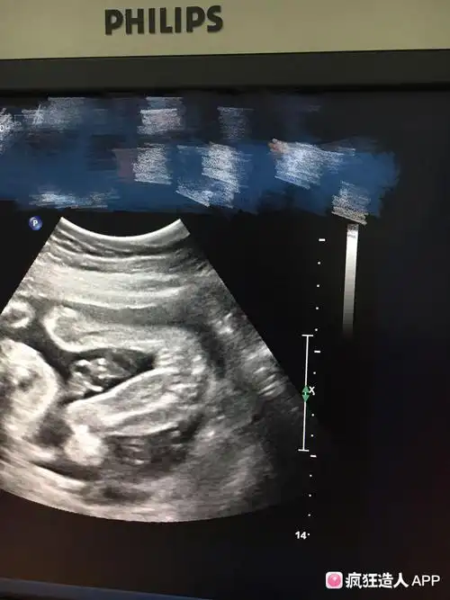 求问我这三条线是肯定女宝了吗?