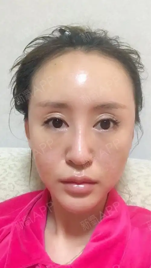 自体脂肪全脸填充好不好_效果图_张张张颖自体脂肪全脸填充术后第3天