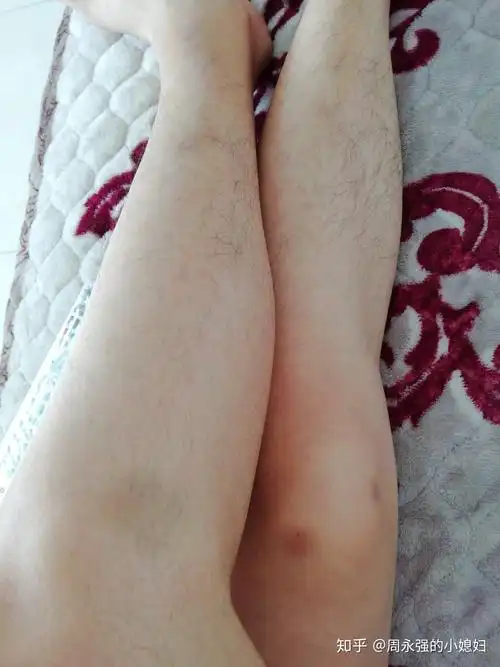 女生有腿毛怎么办