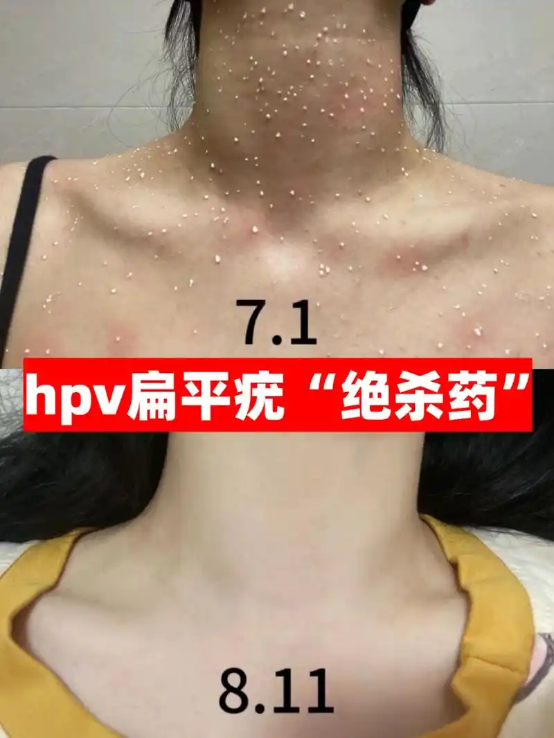 北京协和皮肤科说真话:5个hpv扁平疣"绝杀药"  1,增加代谢——【葡萄