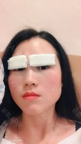 之前都没怎么注意,我睁眼的时候眉毛也是往上抬的,上睑下垂刚做完图片