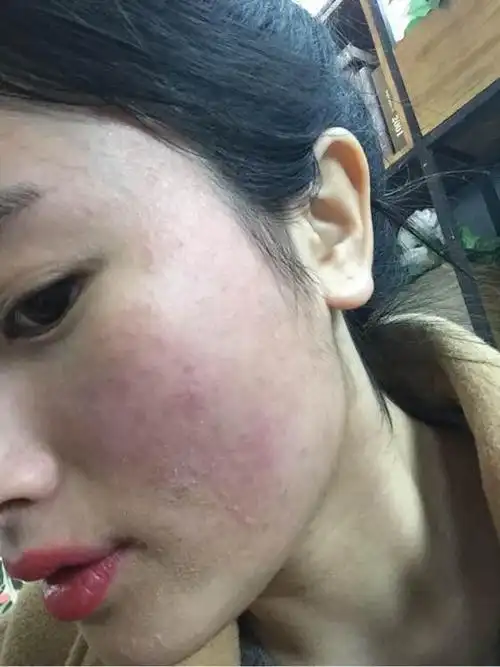 国润生物润品优选 最全皮肤过敏处理方法