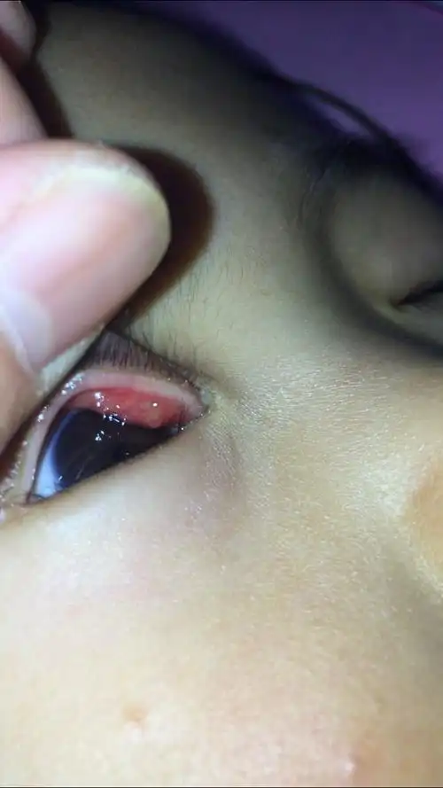 求助:两岁孩子上眼睑内侧,像小水泡一样的东西!请问是什么?