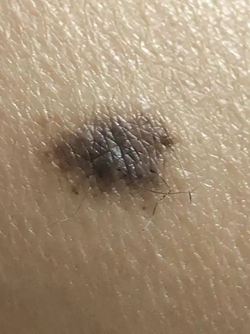 小腿内侧长有一个黑色的痣,大概有三十年了,好像没怎么长,目测有一