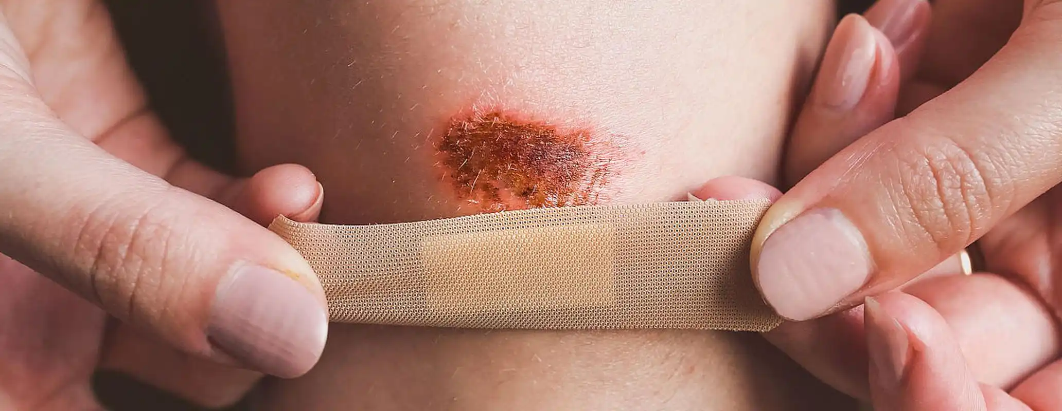 伤口贴创可贴好还是不贴好?