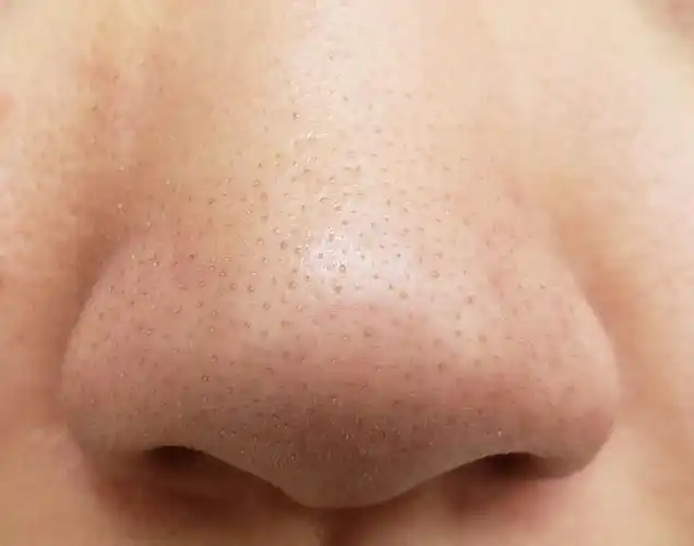 去黑鼻头的方法 -骁龙网